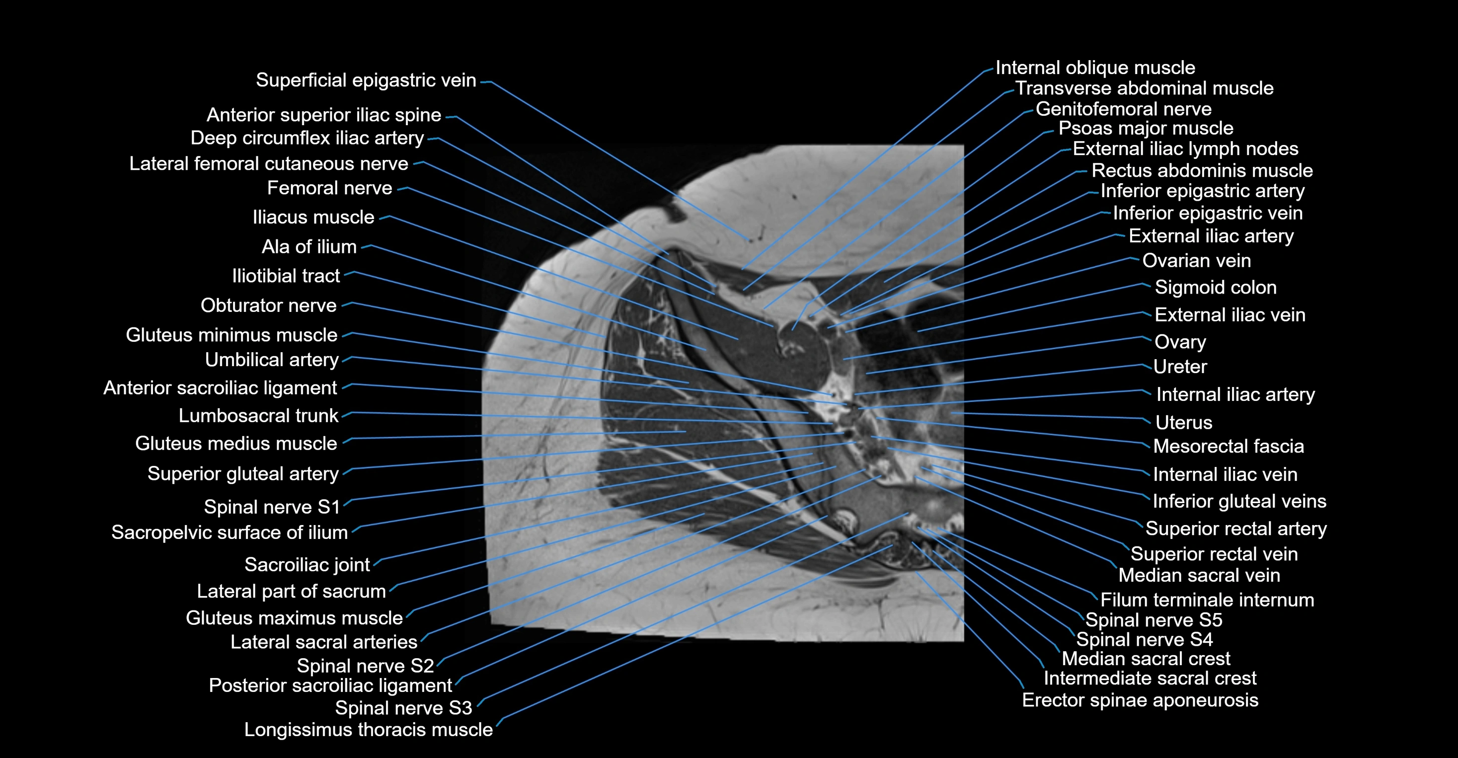 MRI hip axial cross sectional anatomy 3T 3D  radiology  anatomy image-img-00001-00003.webp